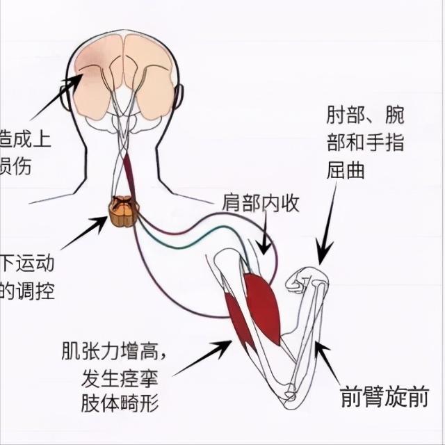 偏瘫上肢伸直困难，2个动作帮你打破屈曲痉挛 偏瘫之后，很多患者都有这样的困扰