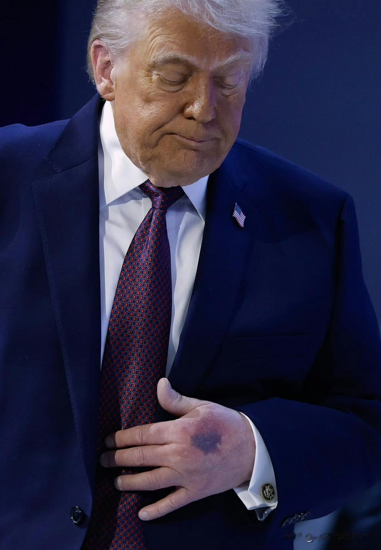 哇塞！特朗普手上这么大一块血斑？每天到底吃多少片阿司匹林？网友:差不多得了……