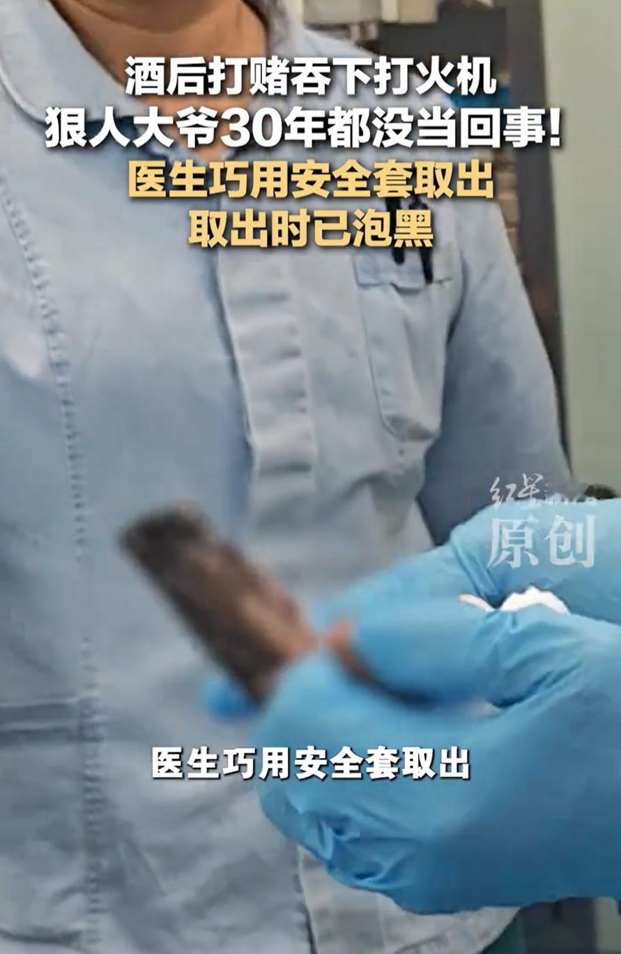 没想到安全套还有这用处！四川成都，一位大爷腹部持续疼痛，开始还以为是消化不好，可