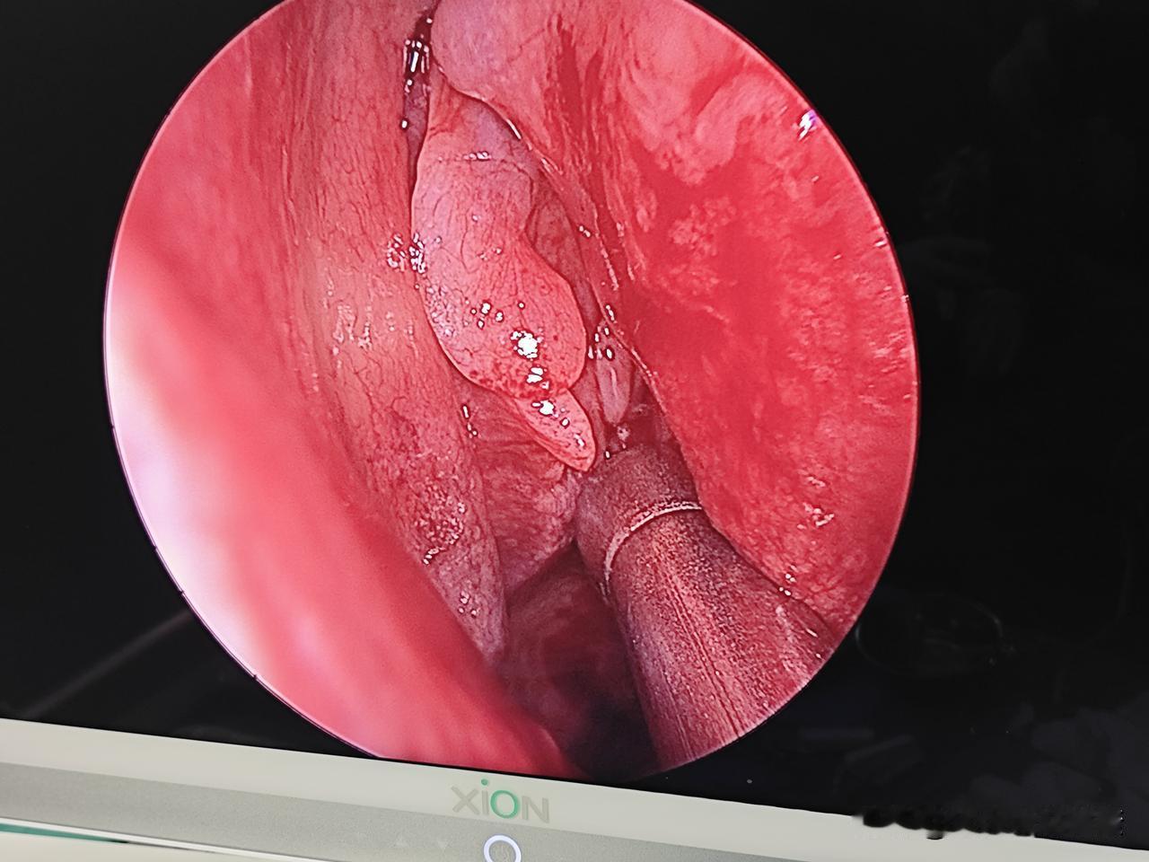 鼻窦炎只有手术能治好吗?关于鼻窦炎的治疗，临床上已经有相关的指南是可以依据的，我