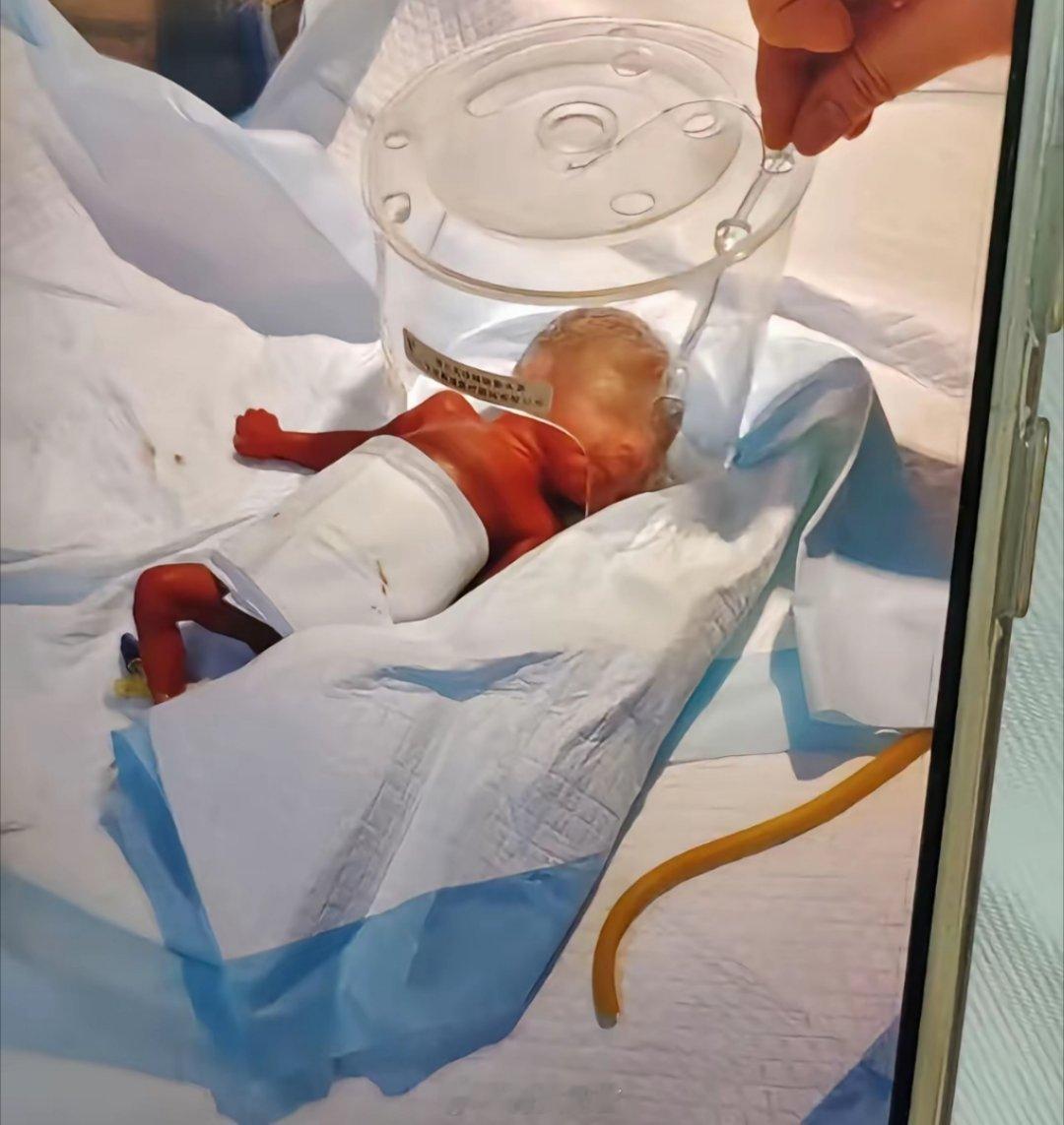 萌娃早产，过程太不容易了，父母和医院这其中的付出可想而知啊。