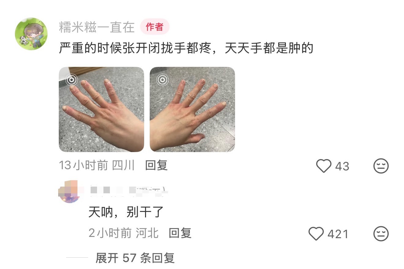 博主说自己在海底捞干了半年手成这样了，评论区有一条​​​