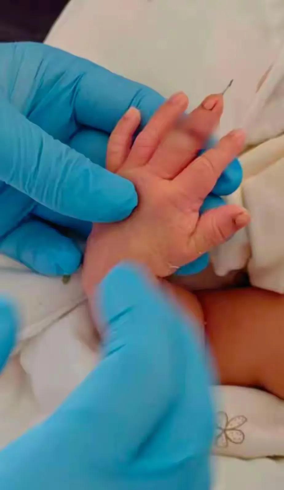 新生儿被剪断手指事件双方达成和解。原本医院答应赔10万，家长不同意，今天下午双方