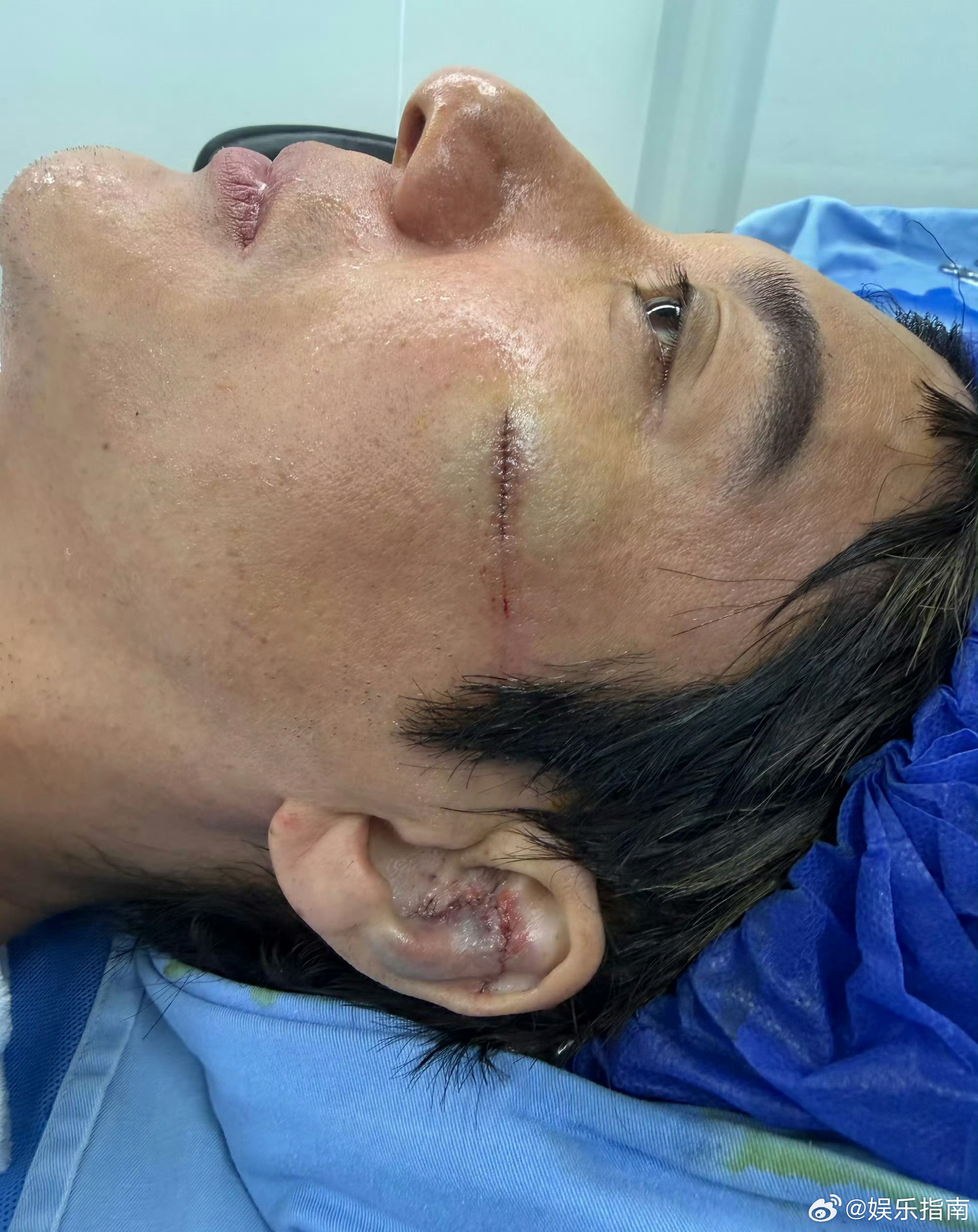 王力宏耳朵缝了27针，这个伤口好严重，耳软骨也撞碎了，光看文字就幻疼了……