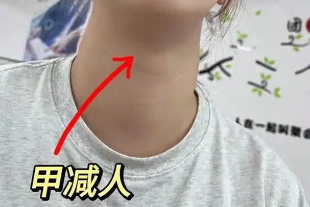 体检单有“甲减”别慌！31万人研究发现：74%其实不需要治疗！ 不少人体检时