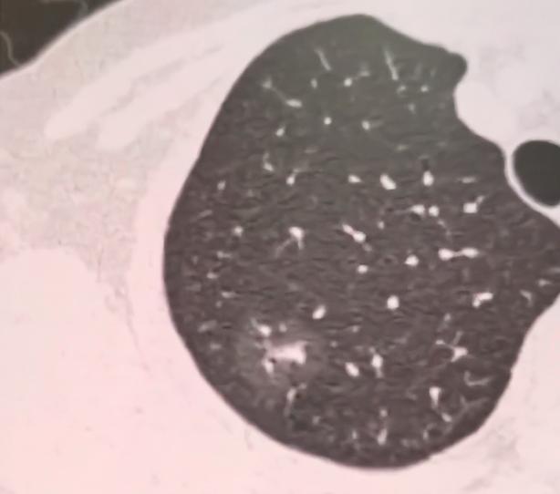 最近碰到一个特别让人揪心的案例，60多岁的阿姨，体检的时候查出了高危混合磨玻璃结