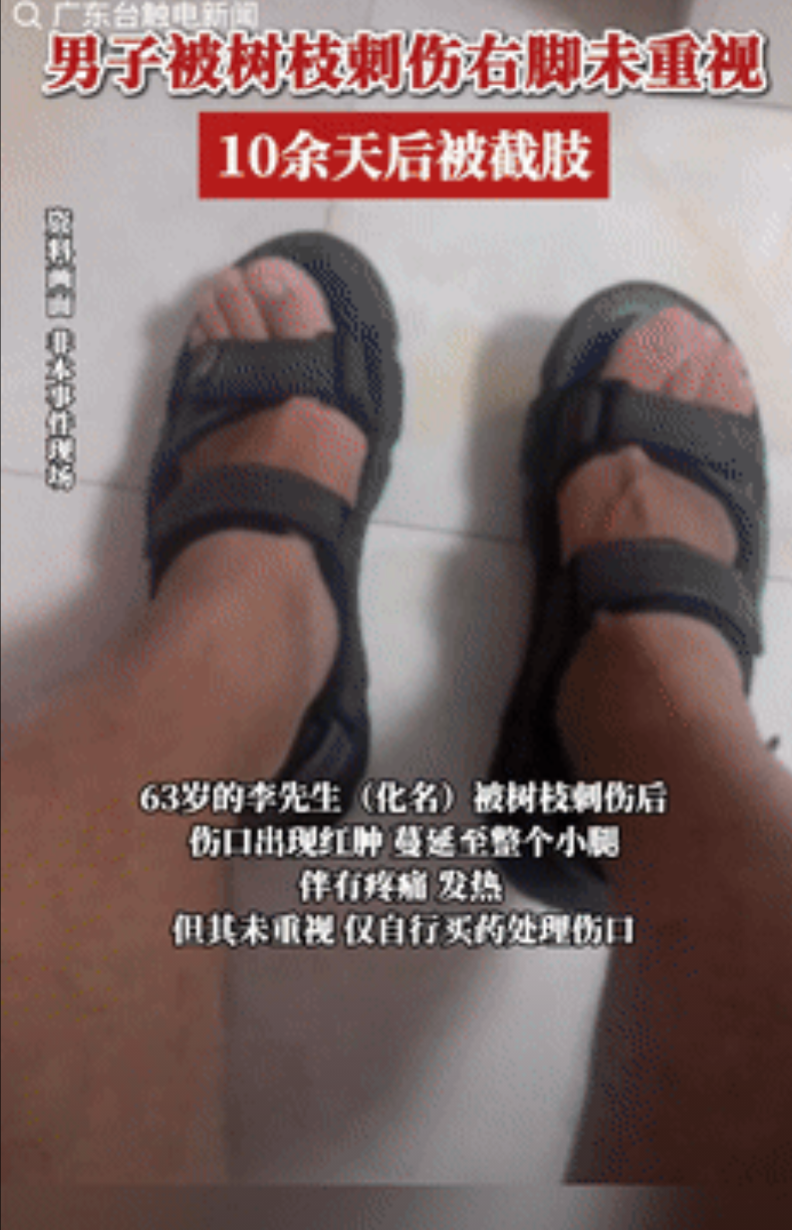 命有一劫！广东，一大爷散步被路上的树枝刺伤，当时只觉得脚上有点疼就没有在意，不料
