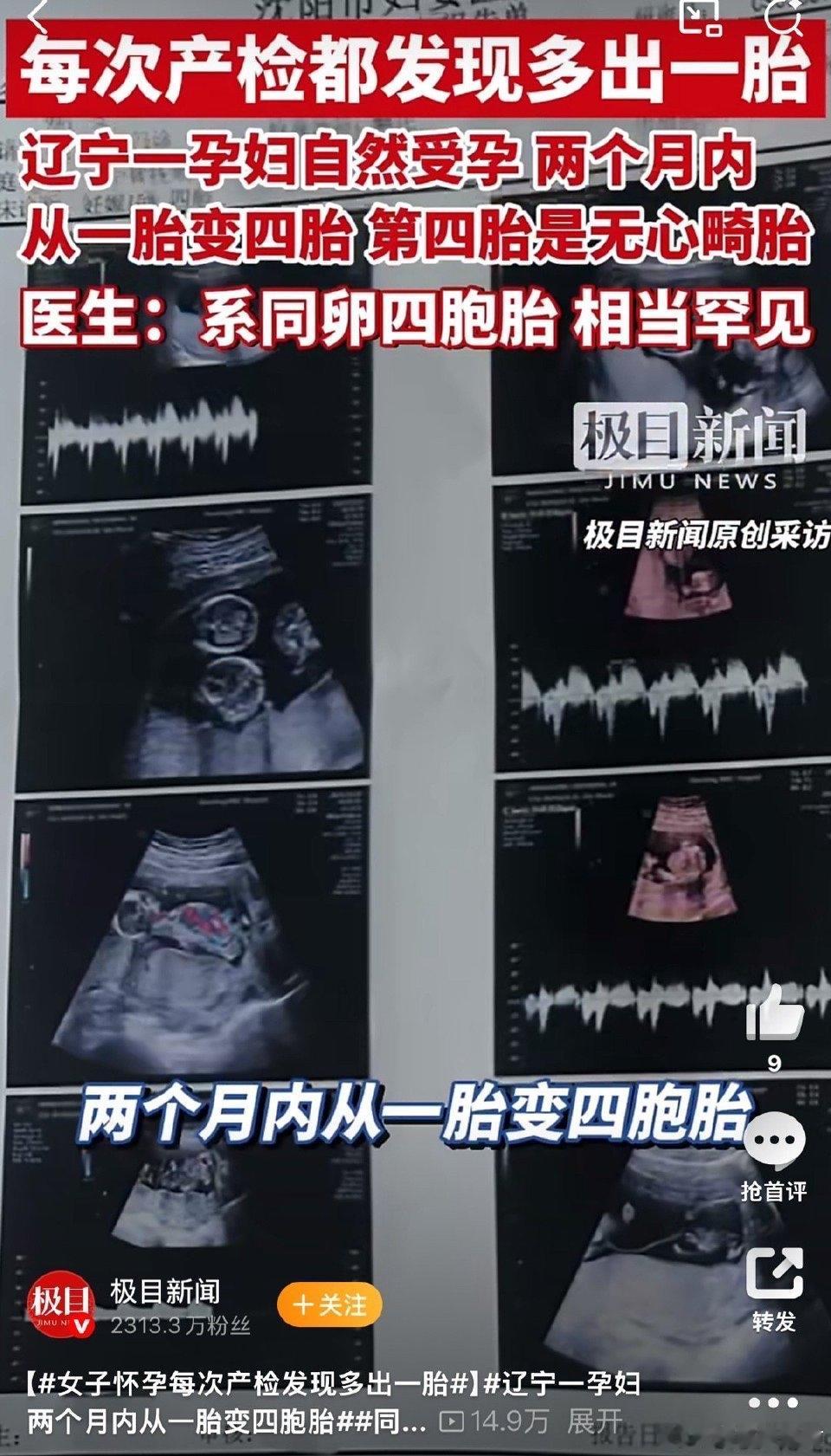 辽宁30岁的王女士怀孕16周，四次检查竟从单胎一路涨到了四胞胎，可这份天大的惊喜