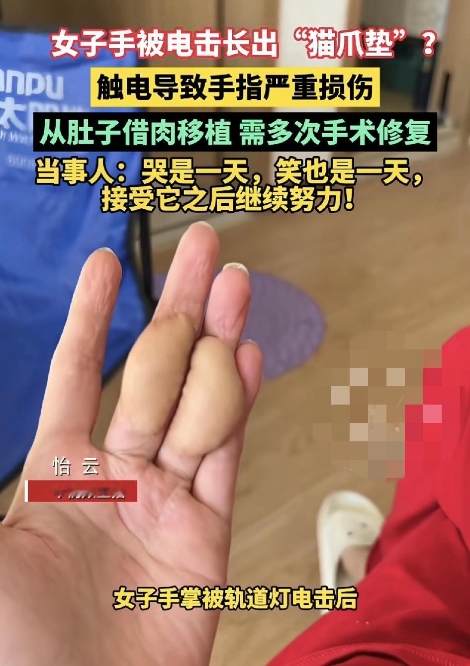 吉林长春一女子接触轨道灯不慎被电击，手指长出了似猫爪垫的形状，后续还要多次进行手