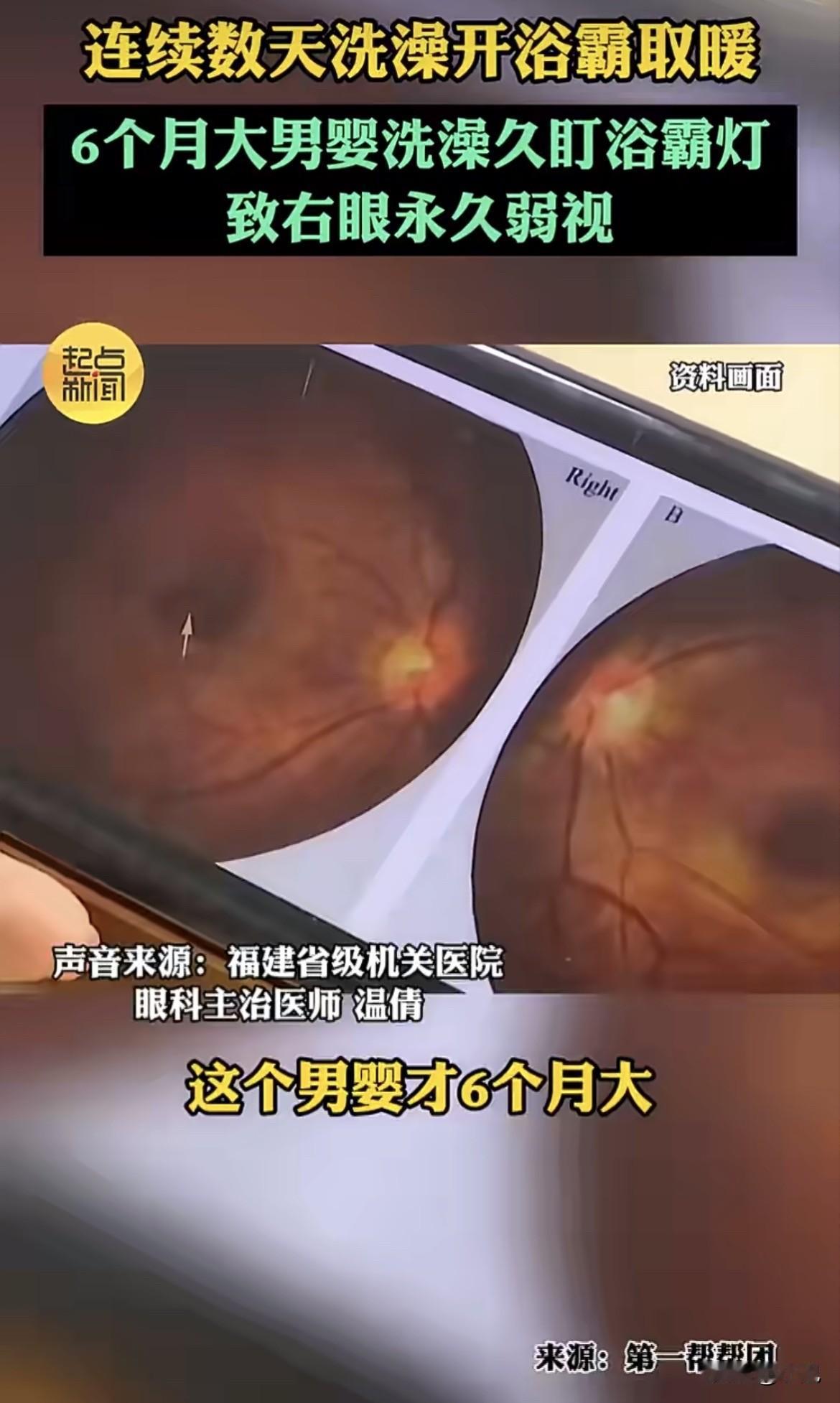 警惕！福建一位妈妈给6个月大的儿子洗澡，怕孩子冷，打开了浴霸取暖。几天后，孩子开