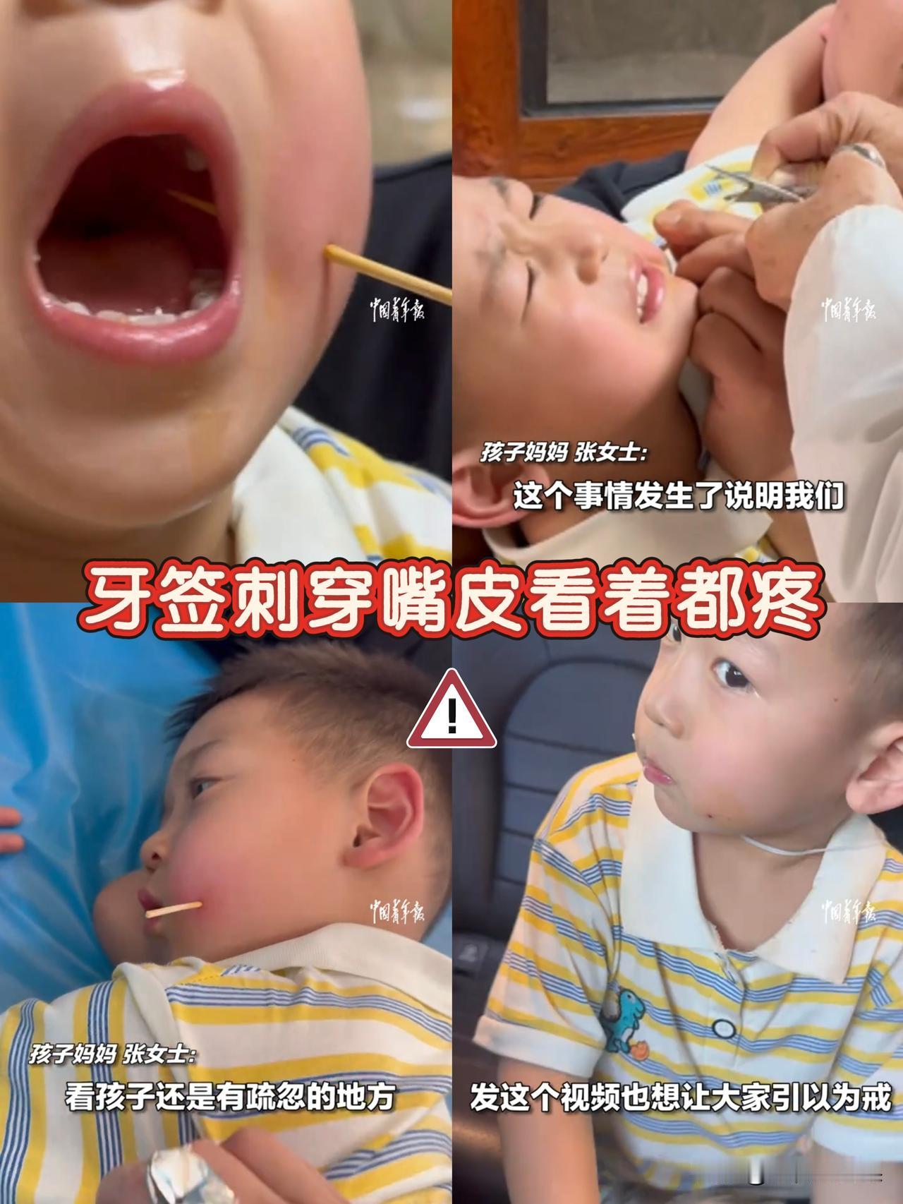 云南那个被竹签扎穿脸的娃，看得我浑身冒冷汗。就因为爸爸吃完糍粑，把竹签随手