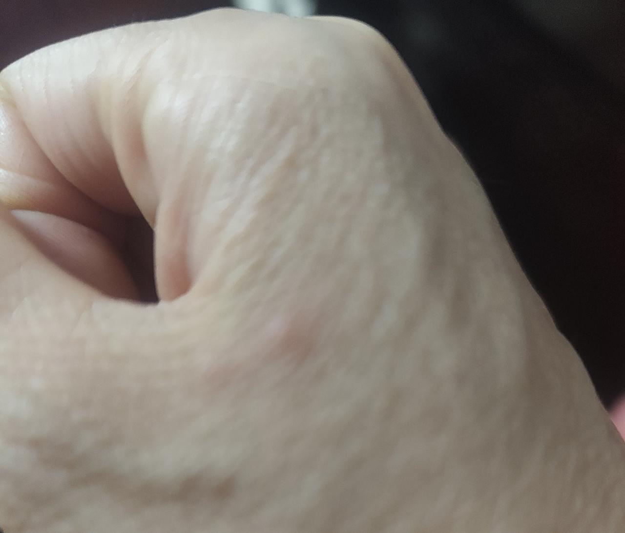 我被咬了，很疼。我被一微小的蚂蚁咬，是什么体验？我昨天被蚂蚁咬了，我不小