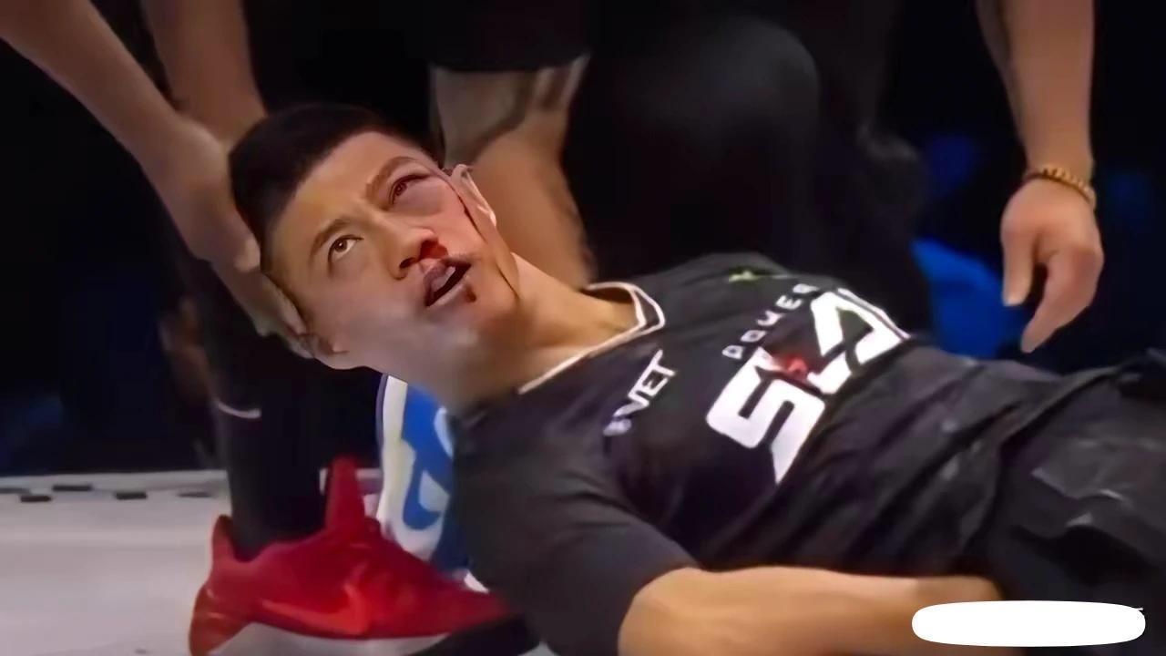 通臂拳这哥们现在出现眼睛看东西流泪，大概率视网膜脱落。这一巴掌几乎毁了他一生。今