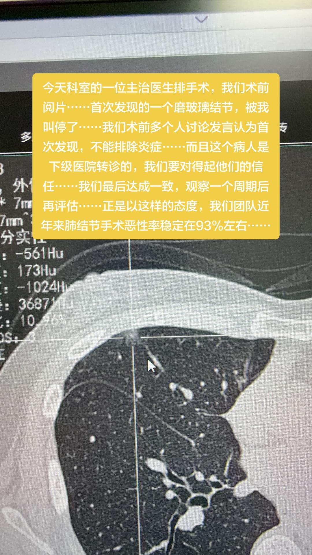今天科室的一位主治医生排手术，我们术前阅片……首次发现的一个磨玻璃结节...