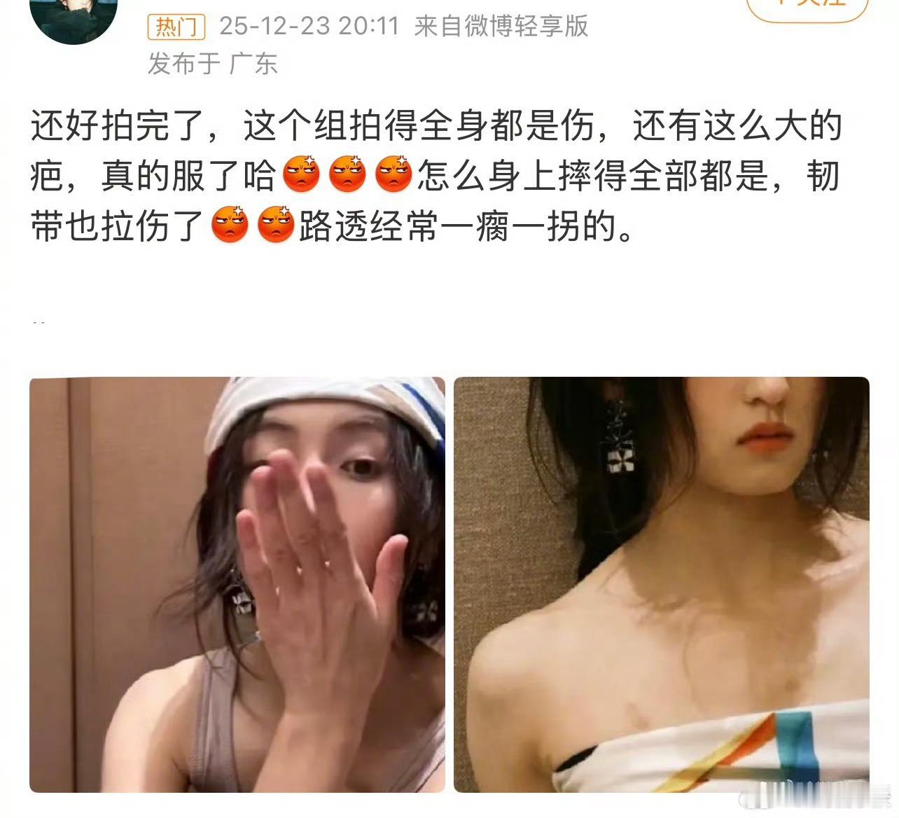 张子枫手臂上好大一个疤天呐好长一条疤痕！妹妹真的很敬业了，心疼。说明演员拍戏确实