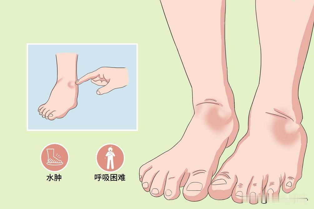 四肢浮肿是何原因？56岁男性患者半年前开始出现下肢浮肿，最开始是脚踝浮肿，后