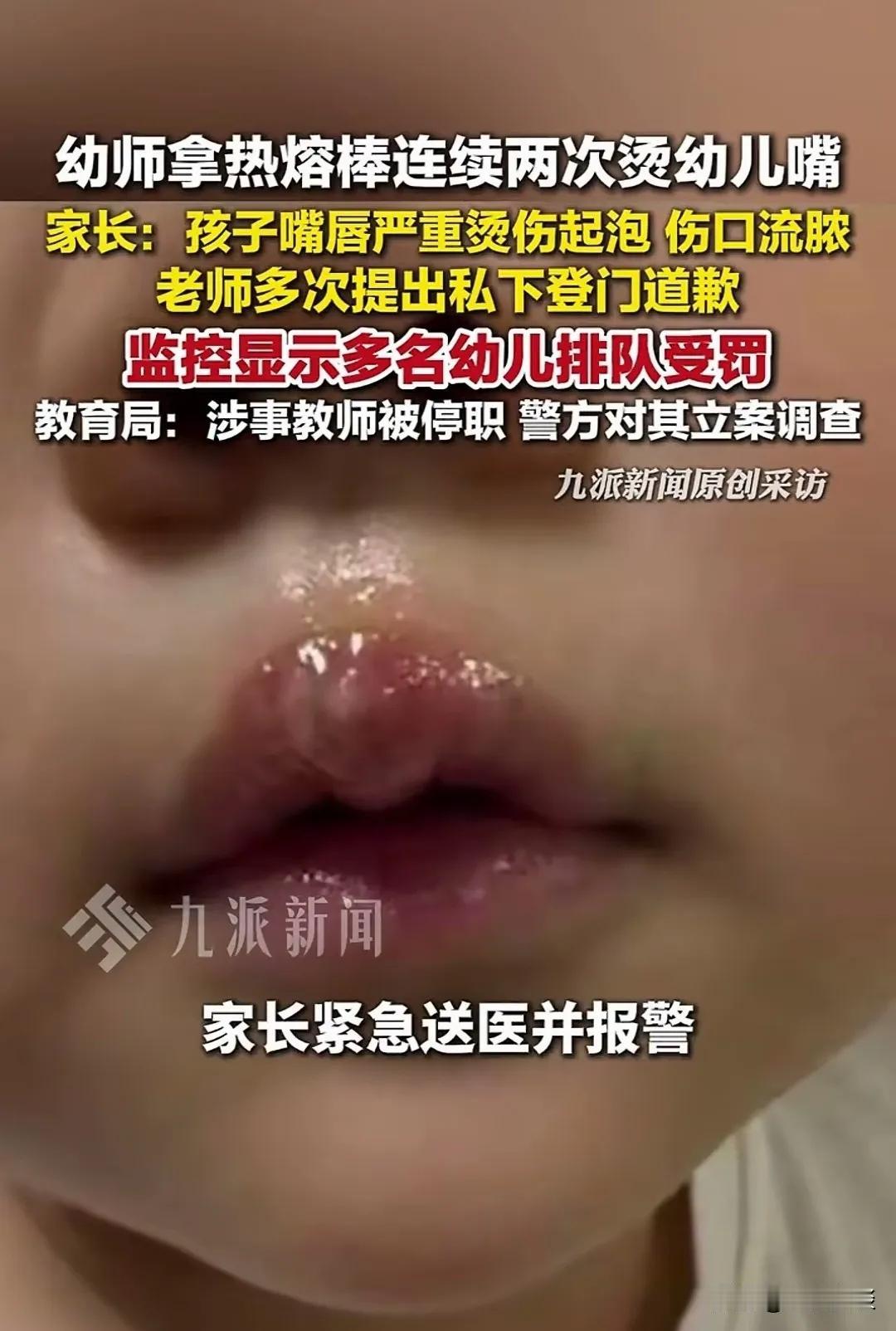 我看不下去了。😡😡😡这个幼儿老师好毒啊。惩罚幼儿，居然用热熔棒把孩子烫