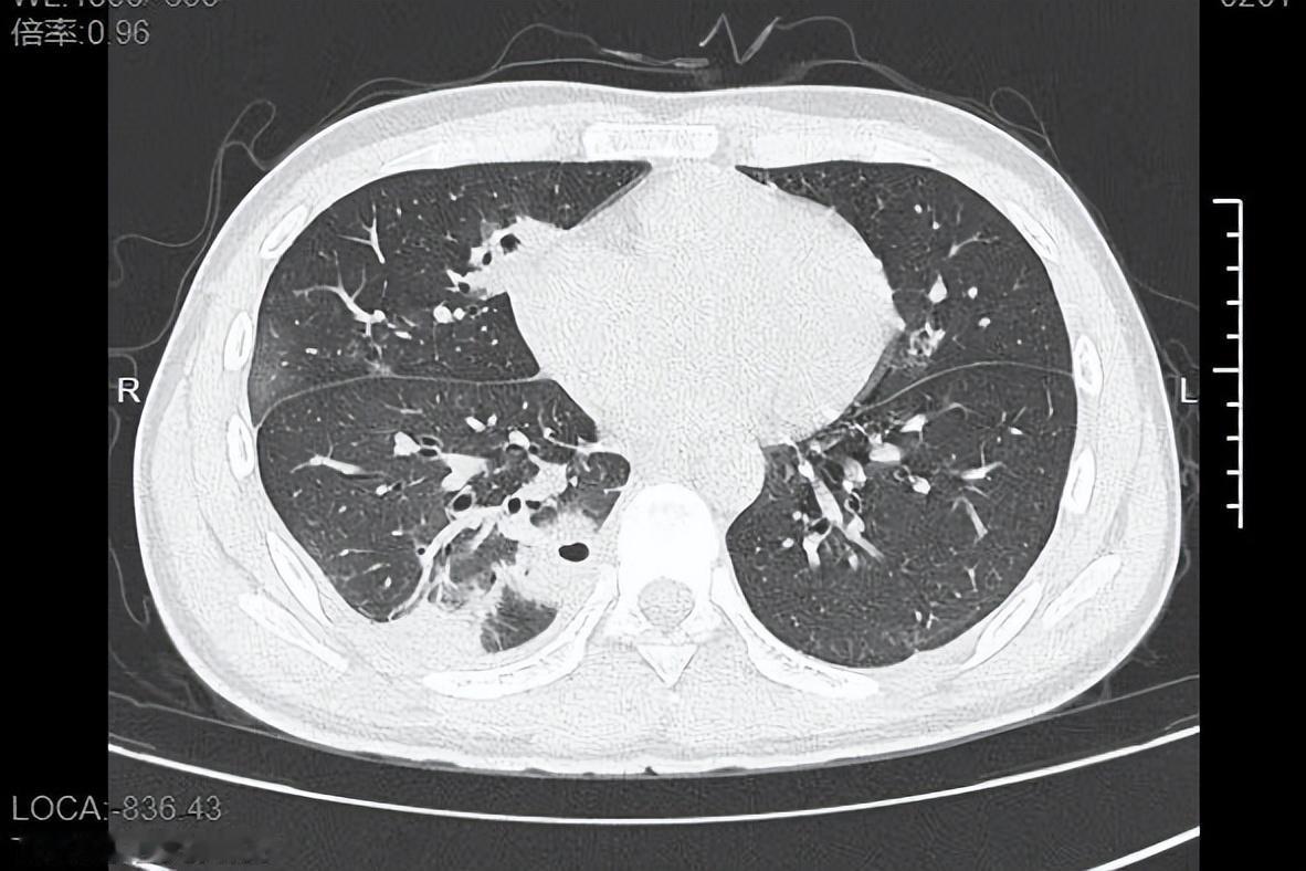 “我再也不手欠了！”浙江宁波，一名大二男生看到脸上长了几个痘痘，很影响自己的形象