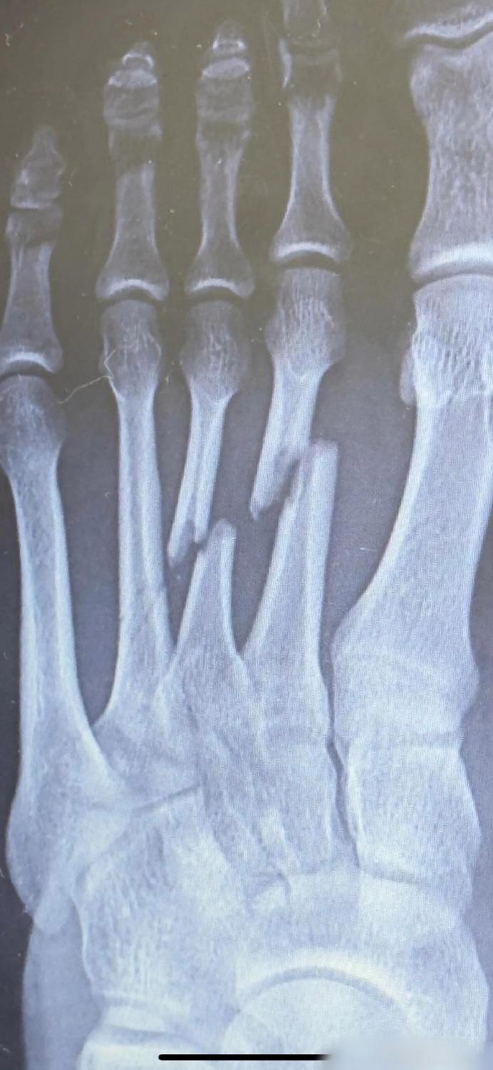 人体的治愈力，骨折后的3个月是这样的！