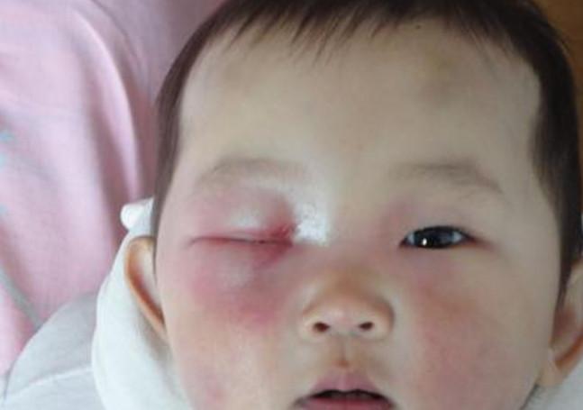 宝宝头上长出脓包, 妈妈很着急, 问了医生后才放心了