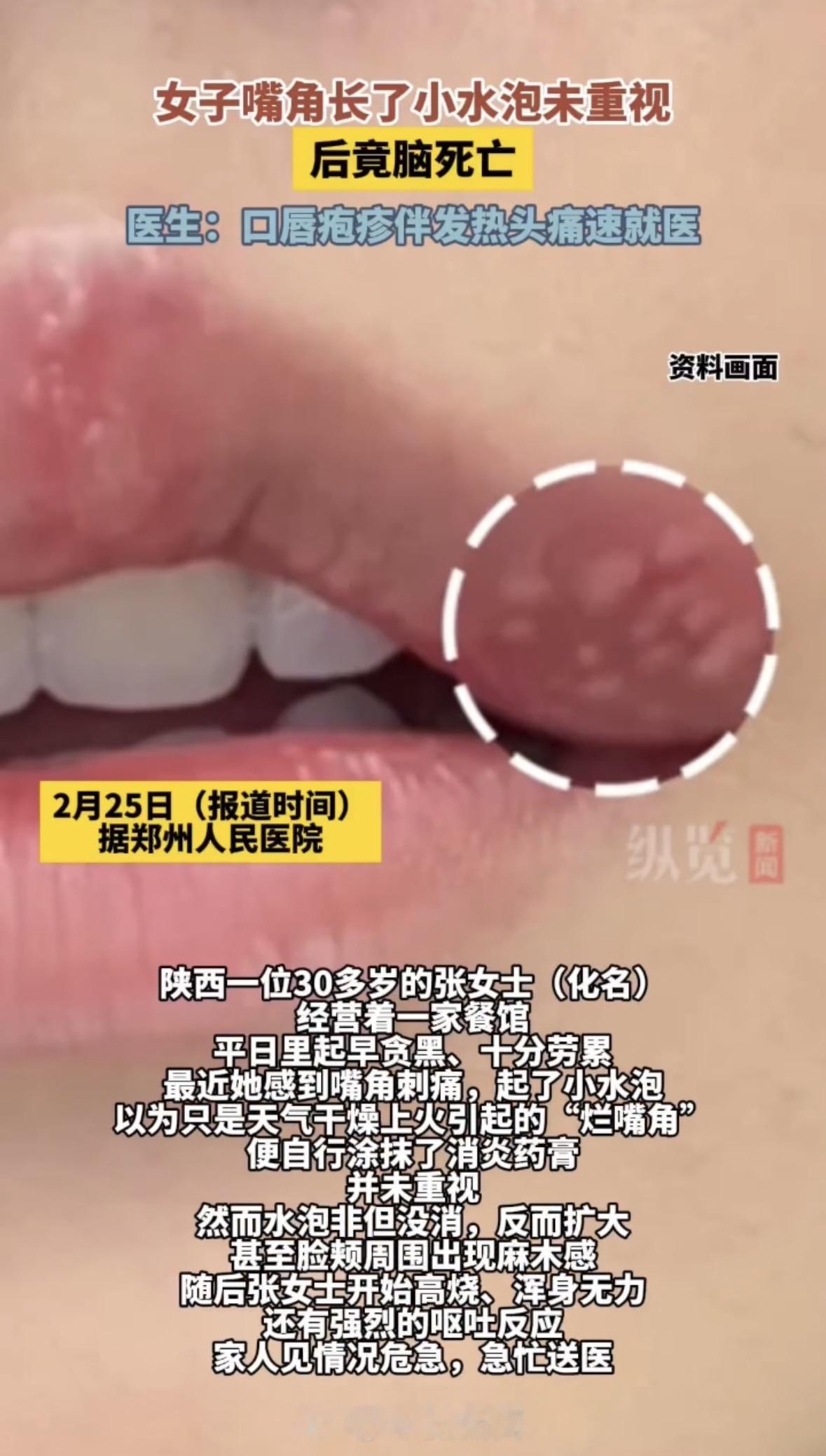 你绝对想不到，就因为嘴角长了颗小水泡，一个活生生的人，说没就没了！刚看到这个