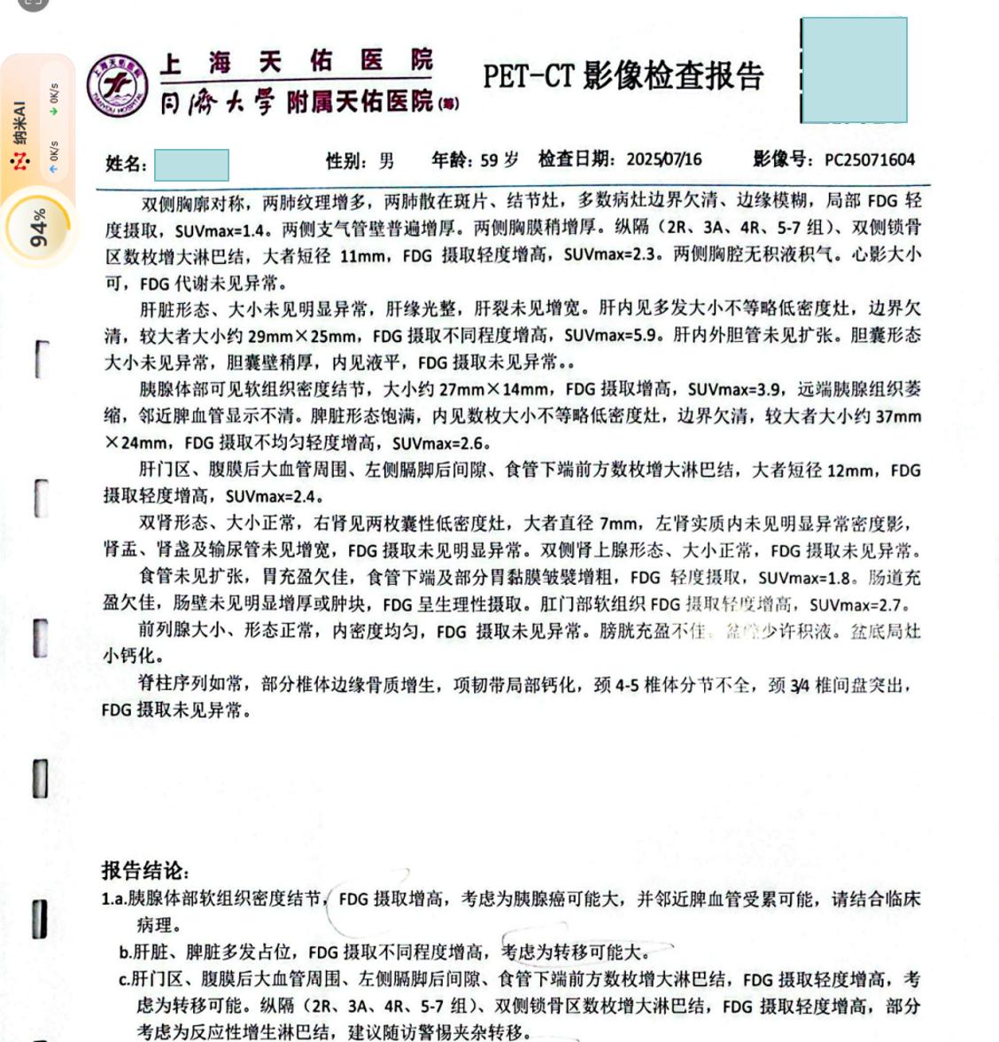 胰腺癌包绕血管不能手术怎么办?病人59岁，男性，患者3个月来出现上腹部不适，一