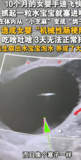 ”太可怕了！深圳10个月大的女婴，因手速快抓了粒水宝宝塞进嘴里，水宝宝在女婴体内