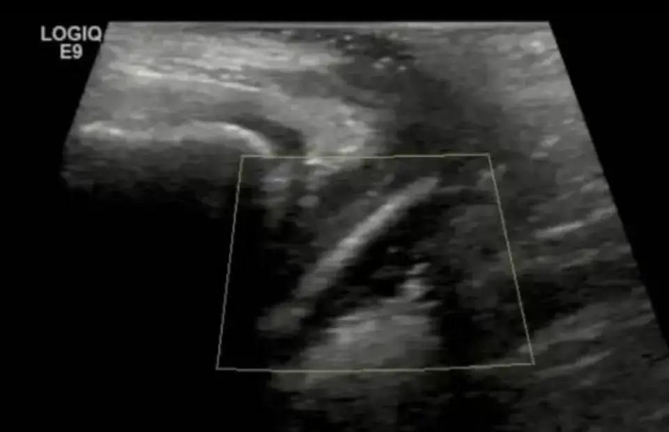 “万万没想到！”近日，广东，一7岁女孩阴道炎反反复复，家长试过什么办法都不见好，