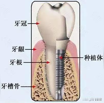 种植牙有那么可怕吗?任何手术都有风险，任何手术失败了才可怕，不失败可怕什么？真