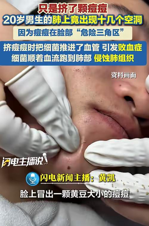 悲剧了！20岁大学生嫌脸上痘痘难看，以为挤掉能快点好，结果，痘痘依旧化脓了，甚至