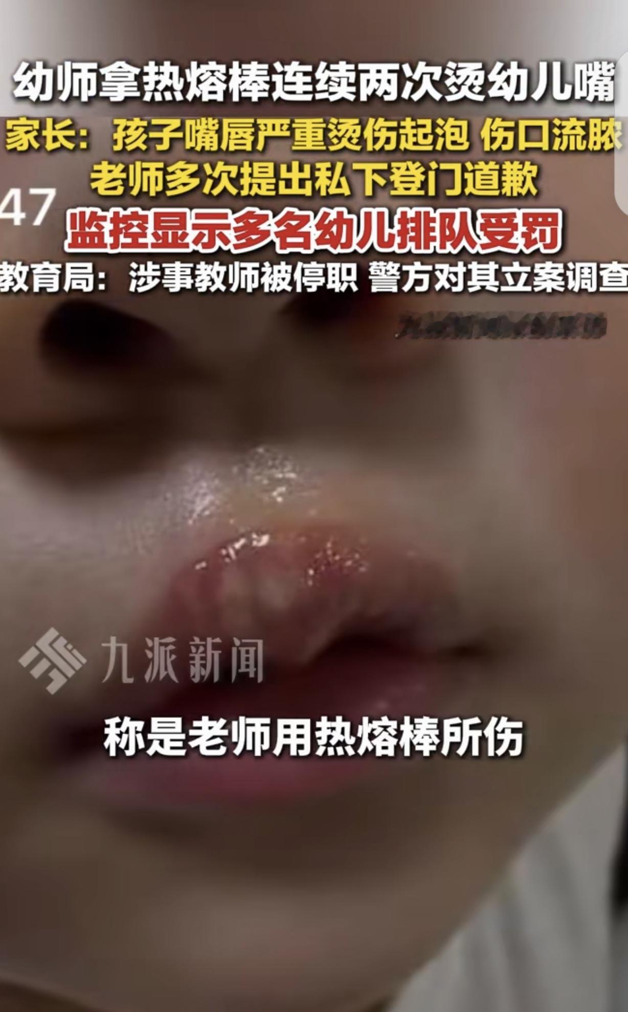 江苏徐州，一女子发现，孩子从幼儿园回来，嘴唇起泡，伤口流脓，一问才知道，是女幼师