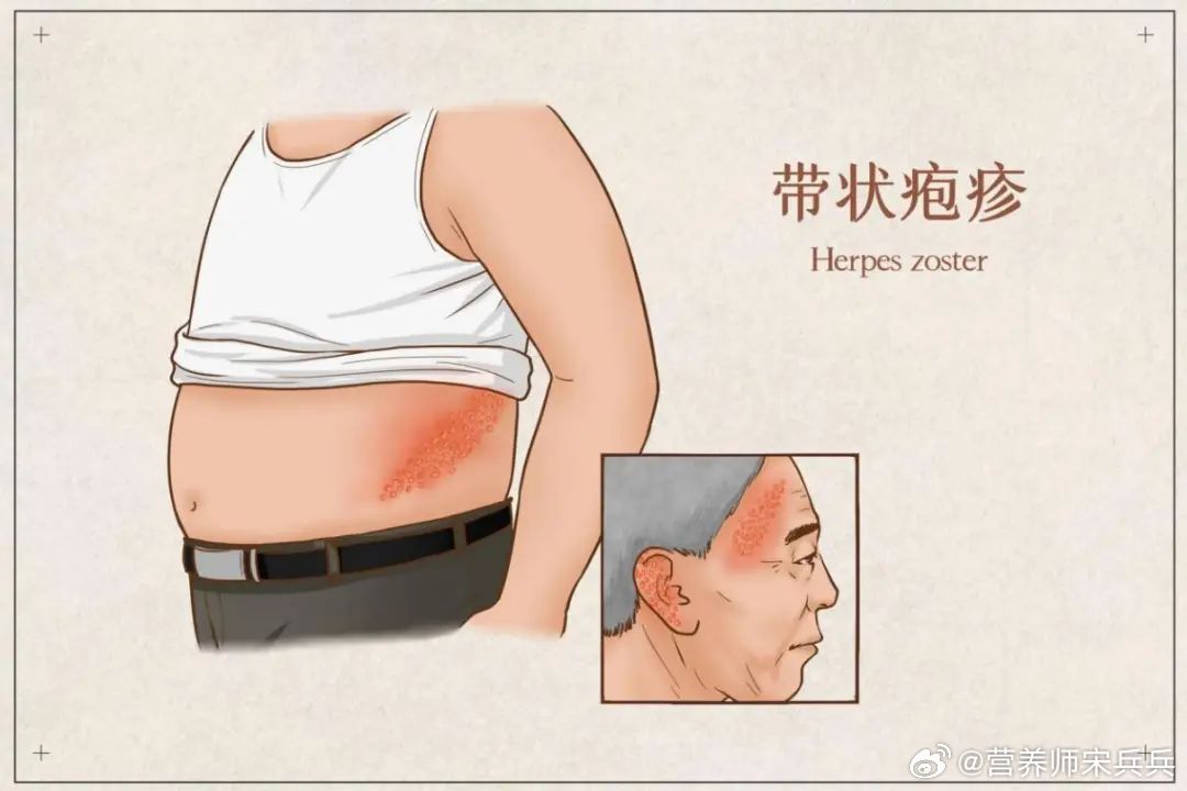 慢病人群更需警惕带状疱疹全民慢病健康科普计划更年期女性易患疱疹吗？更年期女性确