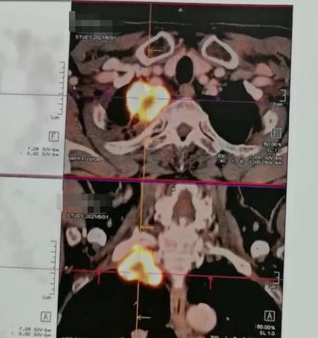 手臂疼到抬不起？广州50多岁的张大叔，最近几个月被一件事折磨得够呛！右手上臂总是