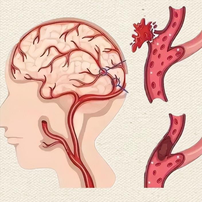 脑梗康复慢？最大的阻碍竟是家属太勤快照顾脑梗家人，很多家属每天从早忙到晚：喂