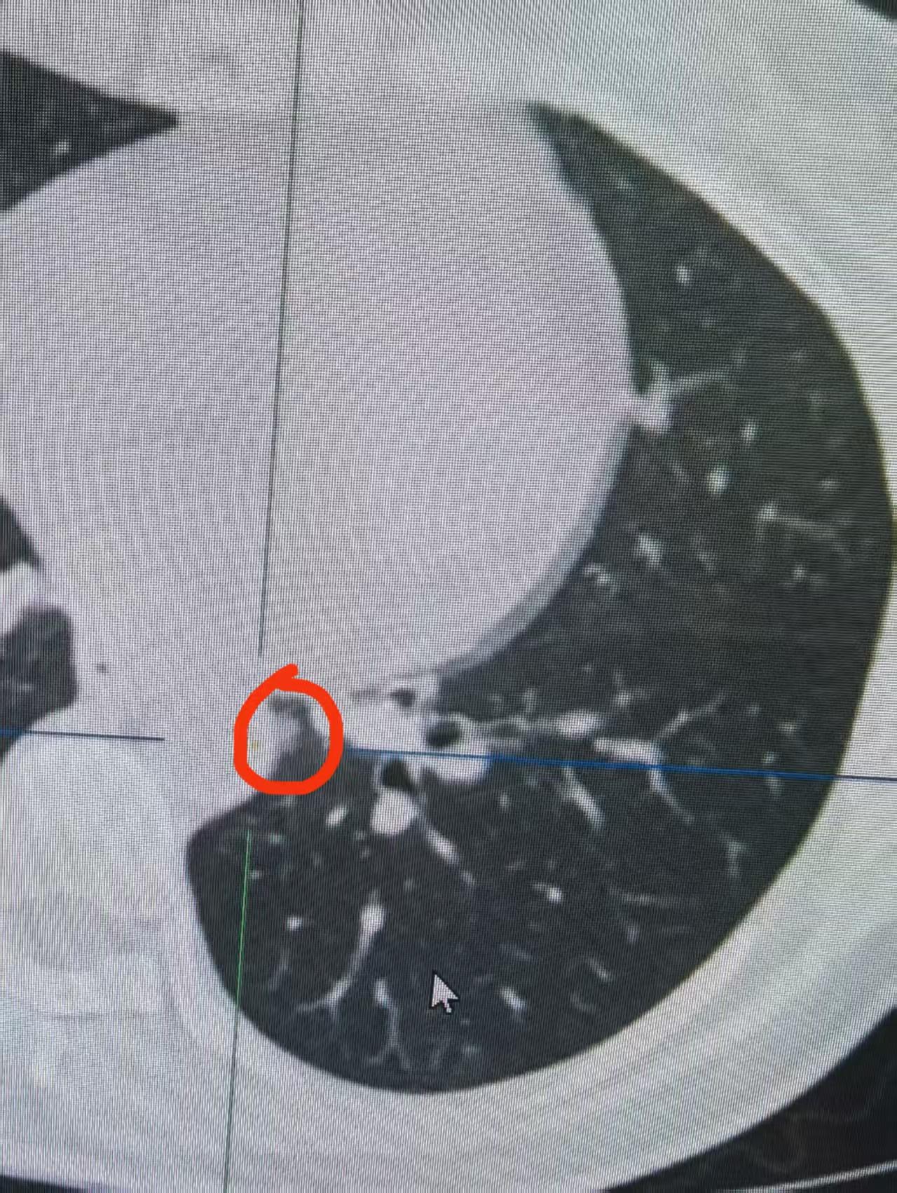 快晚上10点，我刚脱下手术服，结束了今天的最后一台手术。浑身的疲惫感瞬间袭来，肩