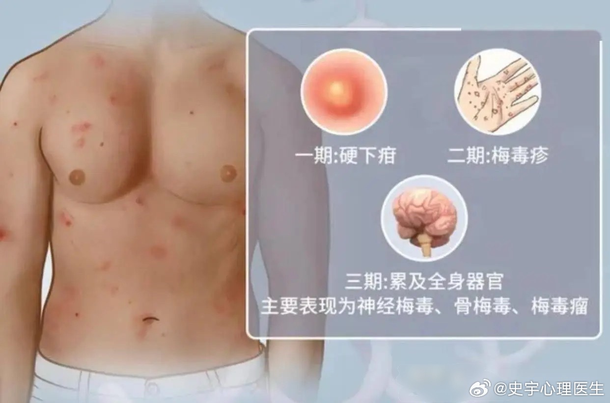 #梅毒越来越困扰年轻人#很多人对梅毒的印象，还停留在会出皮疹、溃烂。但现实里绝大多数感染者，没有任何