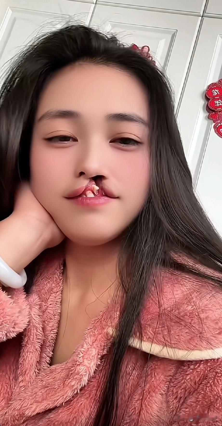 这是一个非常漂亮的女孩，但是非常不幸的是，她一出生就是先天性唇腭裂，在小时候最佳