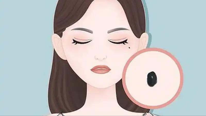 母子双双确诊，1人住院！医生：身上这个黑点不是痣，严重可致命 她以为只是颗痣