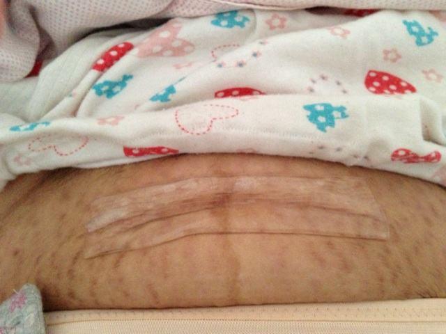 头胎剖腹生下女宝, 月子期间再度怀孕, 婆婆建议说生下来