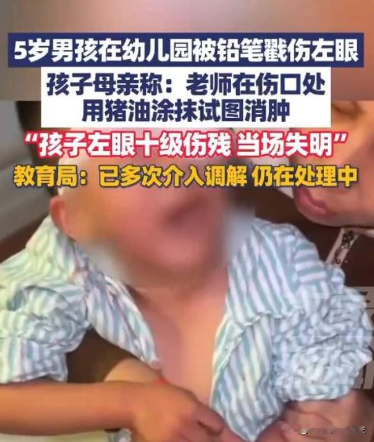 5岁男孩左眼永久失明，只因老师做了一件事10月9日江西瑞昌报道，5岁男孩小宇在