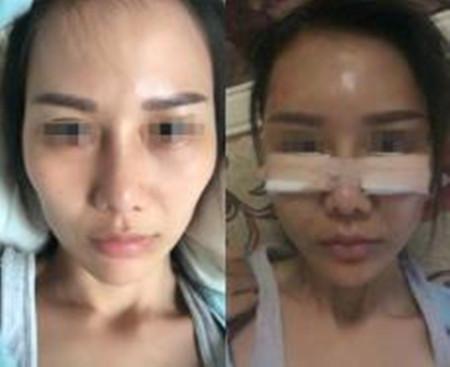 自体脂肪填充后脸颊软软的苹果肌很饱满