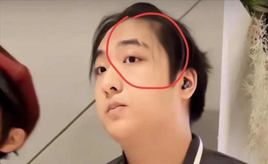 费曼眼睛上的疤痕太大了，还是当年爸爸去哪儿的时候摔倒磕碰的，疤痕比现在还深，已经