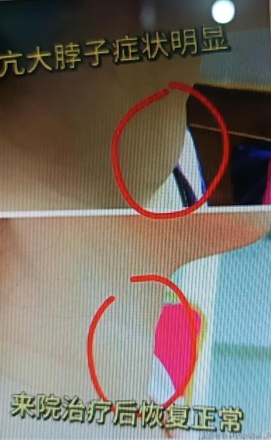 甲亢，全称甲状腺功能亢进症，就是甲状腺激素分泌过多惹的祸。身体要是出现这五个信号