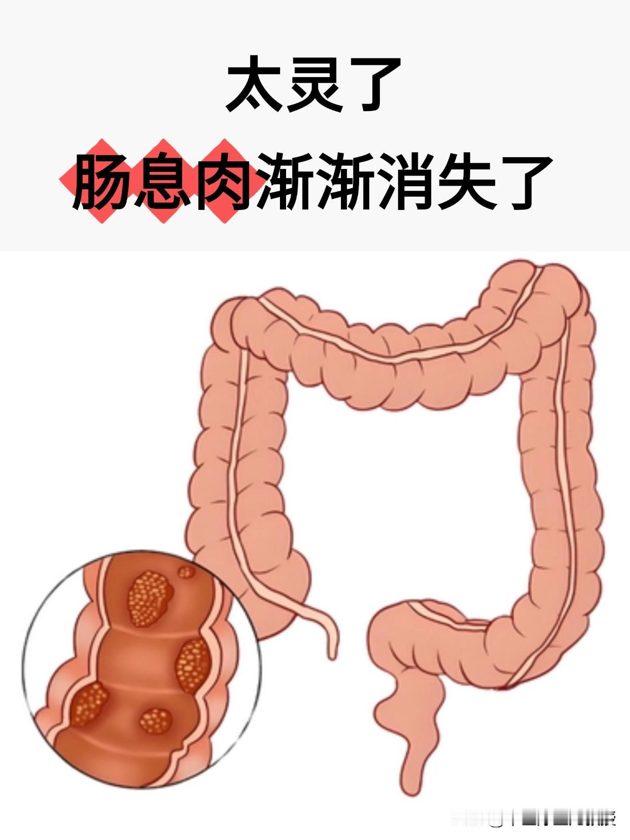 肠息肉：三瘀三调、三时三忌年轻时我在秦岭采药期间，有幸结识了一位隐居深山五十