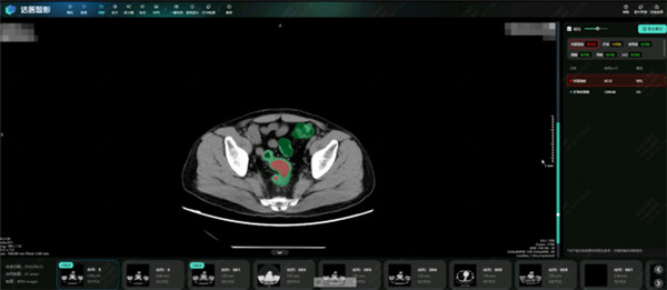 【阿里发布第三个癌症AI模型：接连突破胰腺癌、胃癌、肠癌筛查难题】据媒体报道，阿