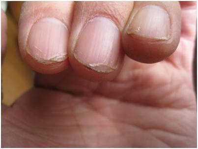 我们的指甲虽然看起来不起眼,但是指甲的一些症状会告诉你身体的一些