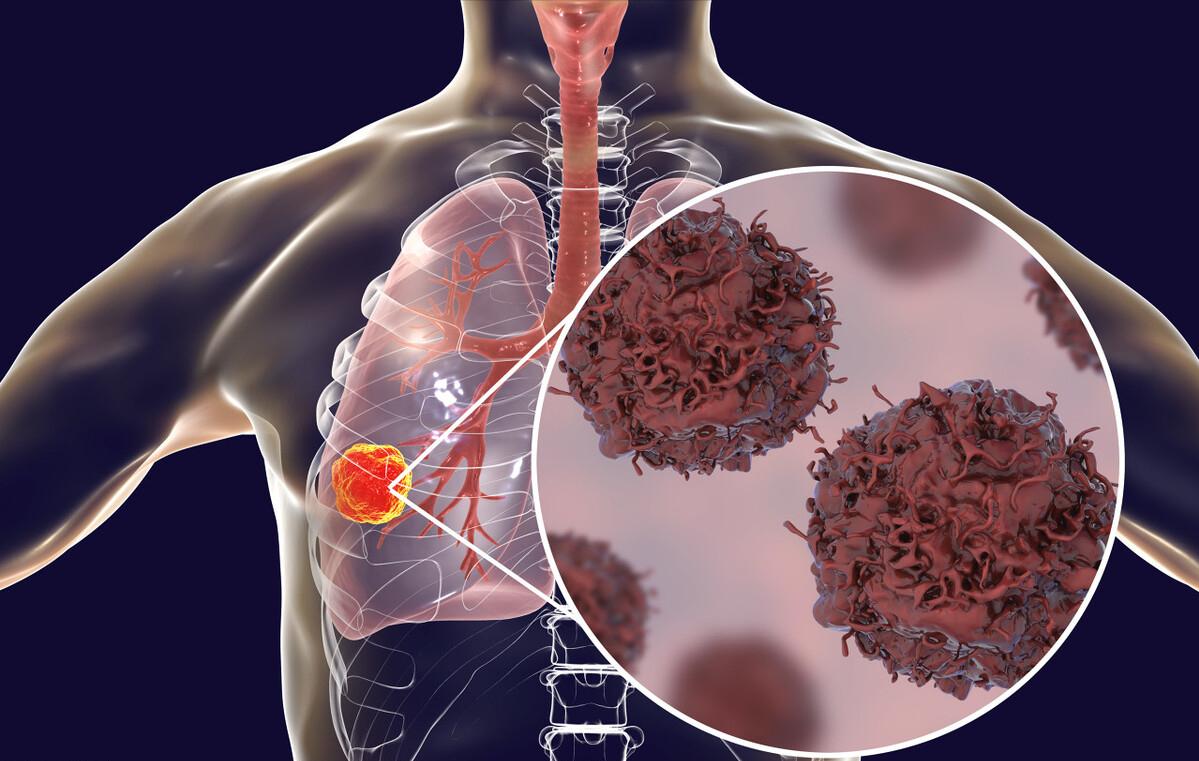 肺结节到底叶切好还是段切好，最近医生热议的话题，病人也很茫然肺结节一般要切除一