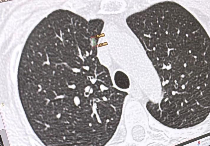 肺微浸润癌有高危因素，靠吃药化疗能更保险？有位患者术后病理显示是“微浸润癌”，但