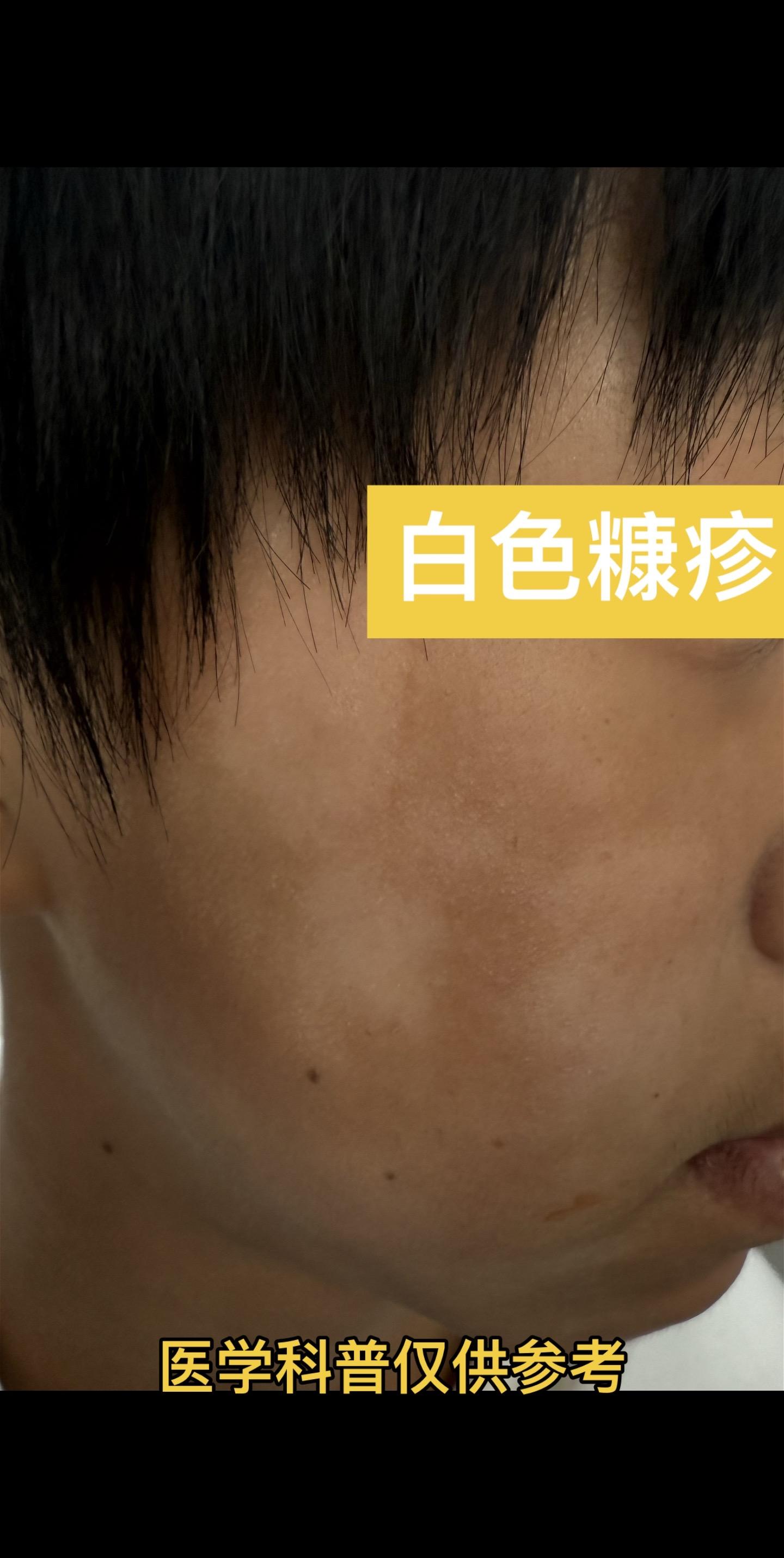 夏季到来，孩子脸上突然出现白斑，有点皮屑，无瘙痒症状，就要注意白色糠疹...