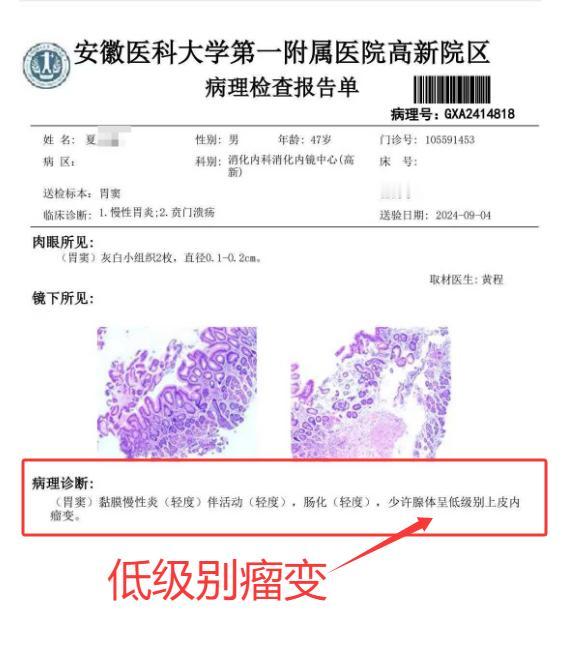 低级别瘤变消失啦！这是同一家医院的先后两次病理报告。低级别瘤变，就是咱们常说的胃